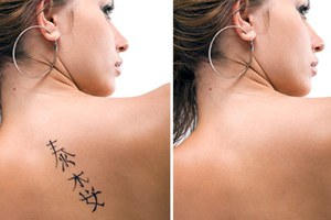 Удаление тату лазером